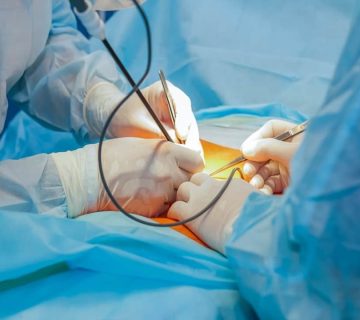 لاپاراسکوپی