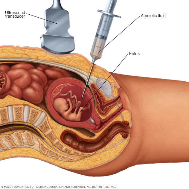 🔹 اختبار بزل السلى (Amniocentesis)
