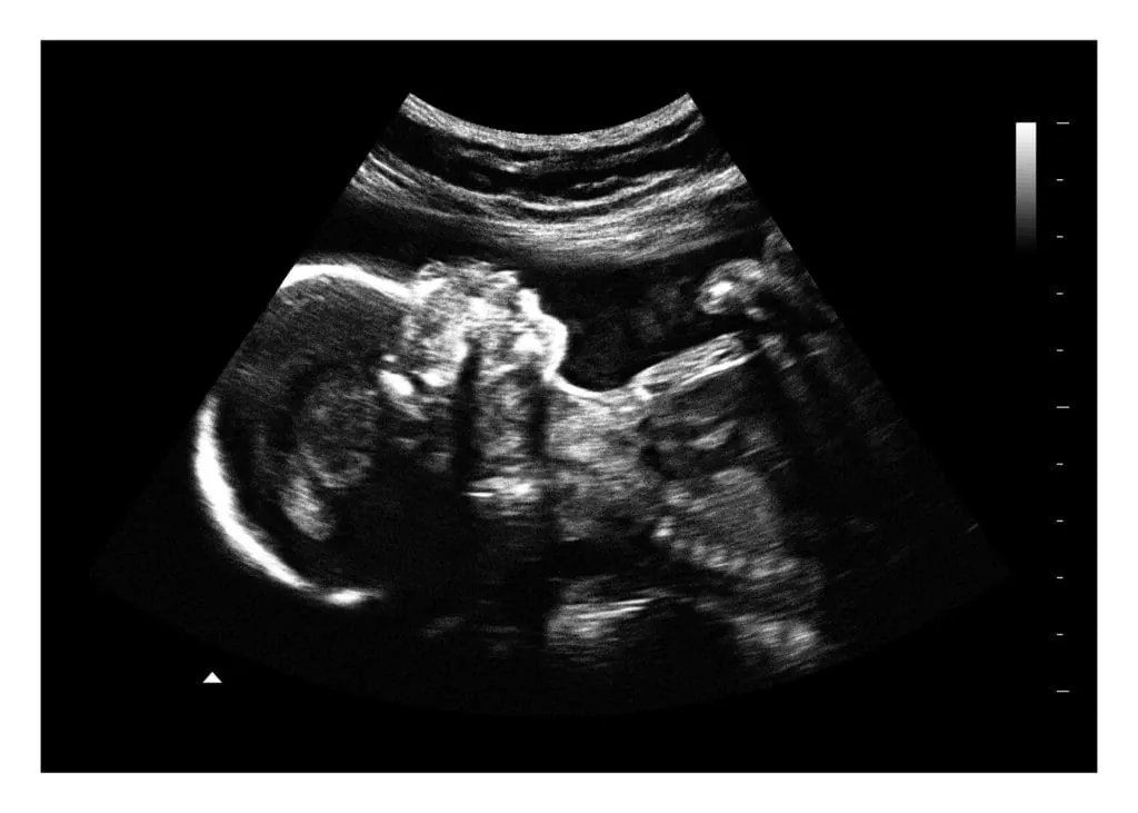 ⭐ Ultrasound at 24 Weeks: What Is Checked?