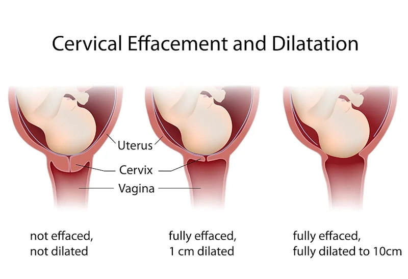 مرحله دوم اتساع — فاز فعال