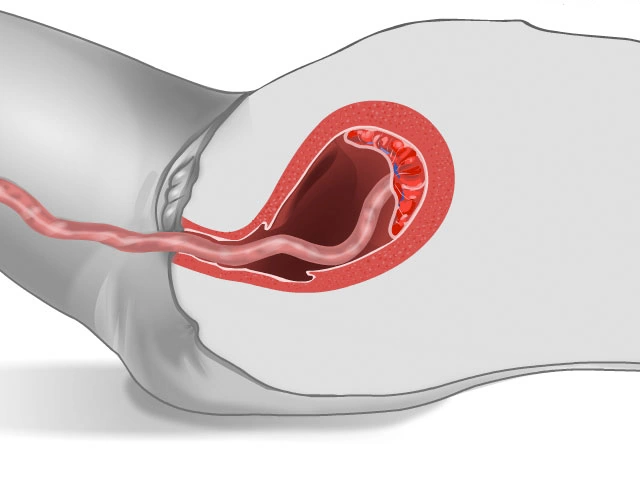 مرحله سوم زایمان (خروج جفت)