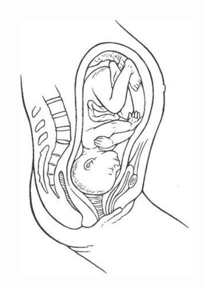 «زایمان پشت» یا قرارگیری پشتبهپشت جنین
