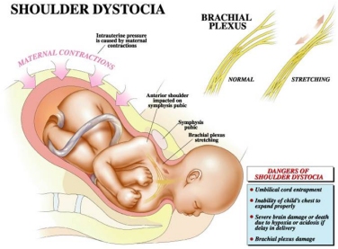 گیر کردن شانه نوزاد حین زایمان