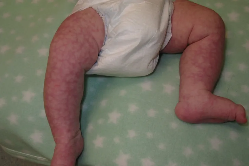 موتلینگ پوست نوزاد