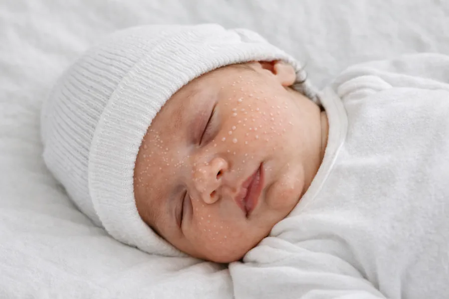 میلیا (Milia) نوزاد یا دانه های سفید روی بینی نوزاد