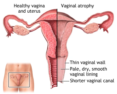 خشکی واژن چیست؟