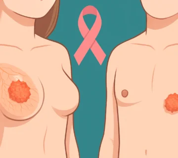سرطان سینه در زنان و مردان