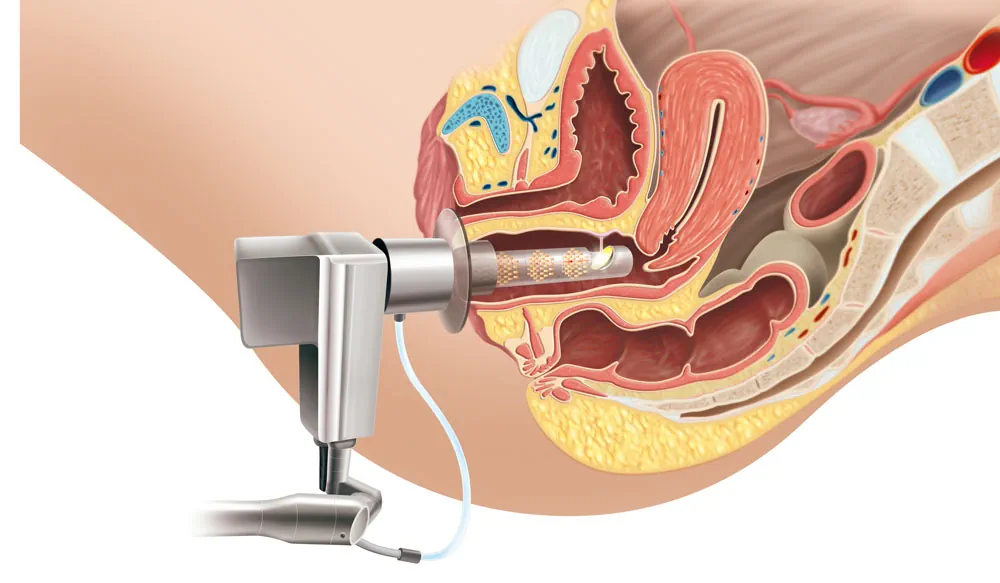 لیزر واژینال چیست و چگونه عمل میکند؟